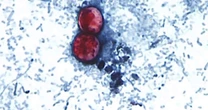 Questions grow over potential impact of budget cuts on response to cyclospora outbreak