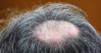 Some doctors worry about rare side effects from taking hair loss prevention drugs