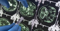 Research shows new blood tests could detect Alzheimer’s disease more accurately