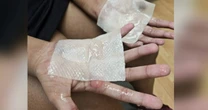 High school dance team member suffers severe burns