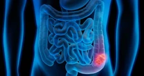 New Study Shows Promising Results in Fight Against Colon Cancer