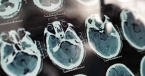 How AI can help detect early warning signs of Alzheimer’s disease