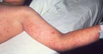 Measles outbreak spreads to 15 states with cases on the rise