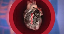 Why are young, healthy adults experiencing a rise in heart attacks?