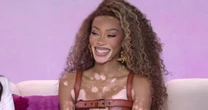 Winnie Harlow Opens Up About Her Journey Living With Vitiligo