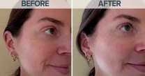 Dermatologist Shares Benefits of Peptides for Skincare Routine
