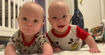 Cleveland Clinic Performs Rare Lifesaving Surgery on Twins