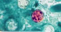 Cyclosporiasis Outbreaks Hits More Than Half of the US