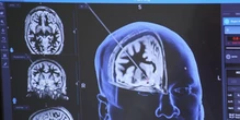 Exclusive: Could innovative brain surgery be tool to treat severe substance abuse?