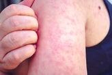 Florida health officials investigate measles outbreak at school