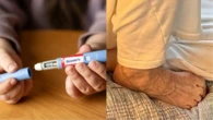 'Pé de Ozempic': pacientes que usam remédio para emagrecer relatam pesadelo