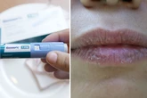 Ozempic deixa a boca seca? Dentistas relatam sintomas bucais de pacientes