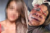 Mulher que levou mais de 60 socos do namorado vai passar por cirurgia para reconstruir ossos do rosto