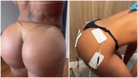 Quando o 'bumbum na nuca' vira um risco? Entenda como pode ser a hiperlordose