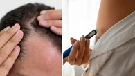 Magro e... calvo: entenda por que canetas emagrecedoras podem causar queda de cabelo