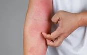 Tratamento para dermatite atópica passa a ser oferecido pelo SUS; saiba como