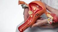 Endometriose: nova forma de diagnóstico promete alívio financeiro e diagnóstico rápido