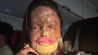Morte de Káh Felipe: o que é xeroderma pigmentoso e quais são os sintomas da doença que aumenta o risco de câncer de pele