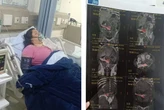 Mulher descobre pinça cirúrgica de 18 centímetros esquecida no corpo três meses após retirada do útero
