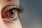 'AVC' nos olhos pode levar à perda total da visão, alertam médicos: 'É bem brutal'