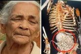 Após queixa de dor de barriga, idosa descobriu que carregava feto há mais de 40 anos