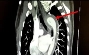 Mulher rompe aorta durante relação sexual e é levada às pressas para cirurgia
