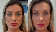 Andressa Urach muda cor dos olhos com cirurgia e se desespera: 'Muita dor, medo de ficar cega'