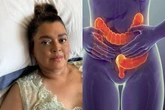 Câncer que matou Preta Gil: como prevenir, reconhecer os sintomas e quando procurar um médico