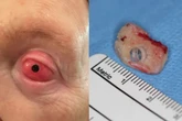 Homem tem dente implantado nos olhos e volta a enxergar; entenda caso