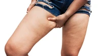 Celulite 'teen': especialistas explicam por que os 'furinhos' surgem na adolescência e o que fazer