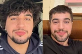 Nattan confessa que se arrependeu de mudança no visual: 'O bonito era o cabelo, não era eu'