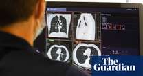 ‘Amazing’ trial shows drug combination stops lung cancer advancing for longer