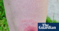 Lyme disease cases in England rise by more than 20% in a year