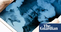The ick factor that could save a life: US cancer researchers look to fecal waste for treatment clues