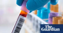 Scientists develop first ‘accurate blood test’ to detect chronic fatigue syndrome