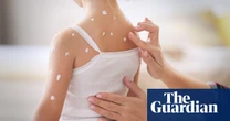 Chickenpox vaccine should be given to children on NHS, JCVI says