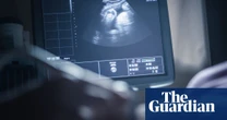 Test developed to identify women at increased risk of miscarriage