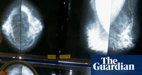 Groundbreaking genomic test could spare millions of breast cancer patients chemotherapy