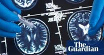 Younger generations less likely to have dementia, study suggests