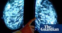 NHS to launch world’s biggest trial of AI breast cancer diagnosis