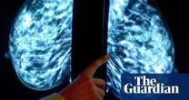 More breast cancer cases found when AI used in screenings, study finds