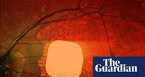 Experts hail ‘remarkable’ success of electronic implant in restoring sight