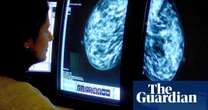 Medics design AI tool to predict side-effects in breast cancer patients