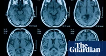 Psychology Myths about brain damage recovery