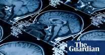 Ten-minute brain scan could detect dementia early, study suggests