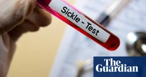 Sickle cell patients to have quicker and more accessible treatment in England