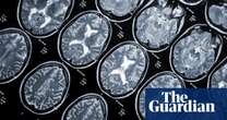 Medical research Common viral antibodies could trigger MS, research reveals