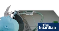Ultrasound ‘helmet’ could treat Parkinson’s non-invasively, study shows