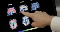 "Inglobate le proteine deformi". Cura per l'Alzheimer, la scoperta che potrebbe cambiare la storia e la battaglia