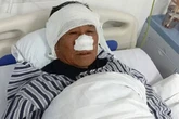 Man who had nose bitten off while saving woman from 'strangler' says 'I would do it again'